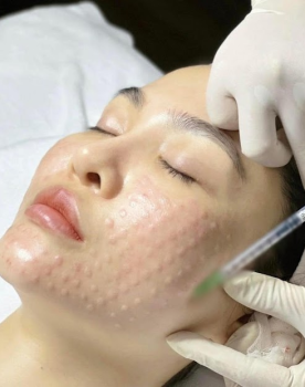 Cấy Meso Dưỡng Trắng 