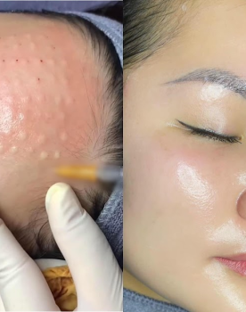 Cấy Meso Căng Bóng 