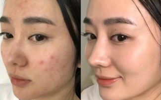 Khách hàng sau 1 liệu trình chăm sóc da-37