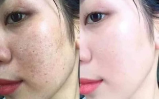 Khách hàng sau 1 liệu trình tại Madam Hồ 