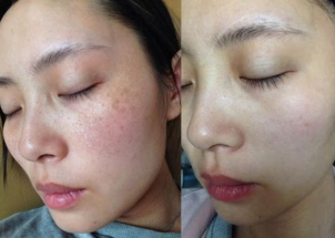 Khách hàng sau 1 liệu trình chăm sóc da