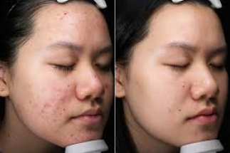 Khách hàng sau 1 liệu trình điều trị mụn