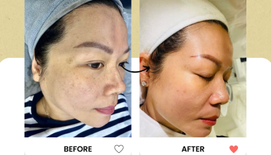 Trị Nám Uy Tín Quận 6 – Hiệu Quả Thấy Rõ Tại Thẩm Mỹ Madam Hồ